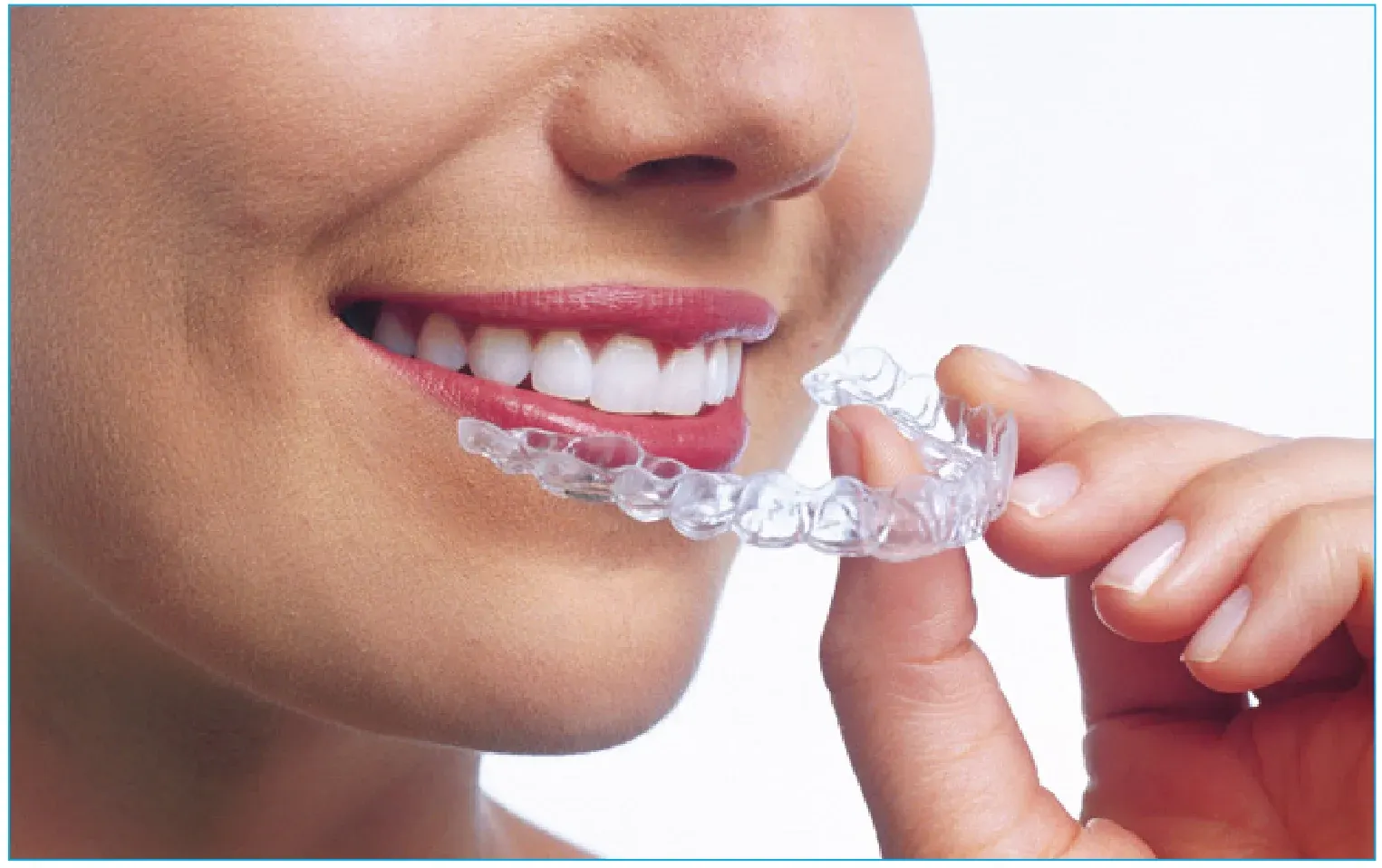 Clear Aligner tannregulering